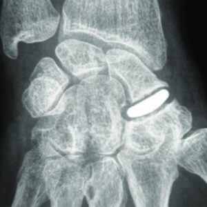 arthrose-scapho-trapezo-trapeziodienne-seivert